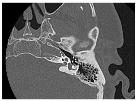 Perilymphatic fistula and pneumolabyrinth without temporal bone fracture: a rare entity | BMJ ...