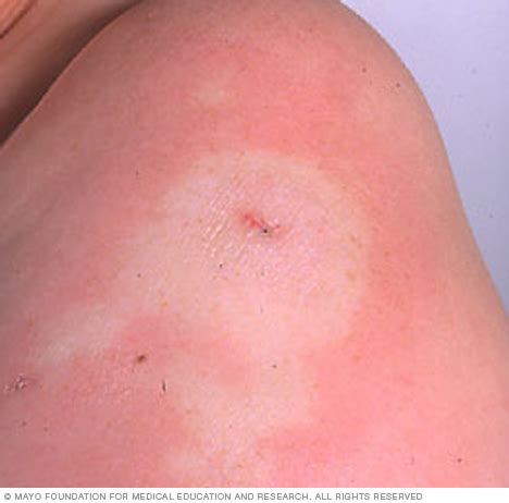 Morphea Disease Reference Guide - Drugs.com