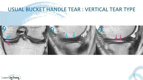 Hemi Bucket Handle Tear Knee MRI - Radedasia