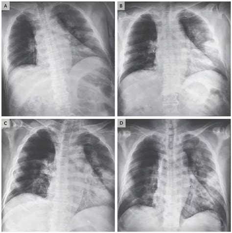 Chest X Ray Detect Coronavirus at tomsharrisono blog