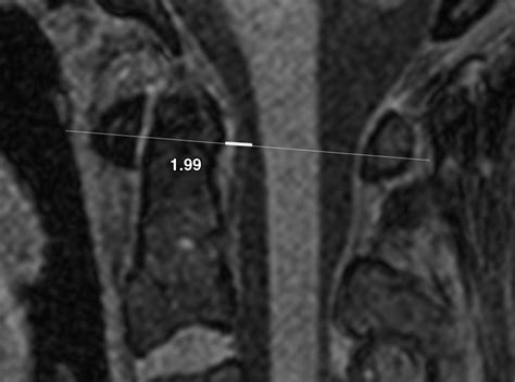 Transverse Ligament C Spine