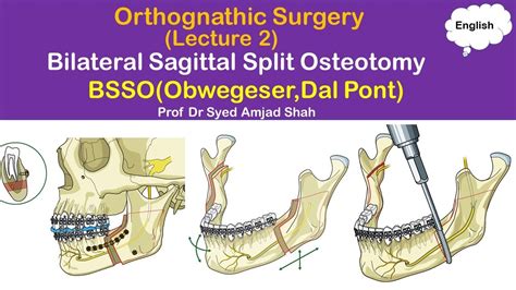 Obwegeser | Dal Pont | BSSO | Bilateral Sagittal Split Osteotomy | Orthognathic Surgery - YouTube