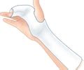 splints/orthotics and amputations/prosthetics Flashcards | Quizlet