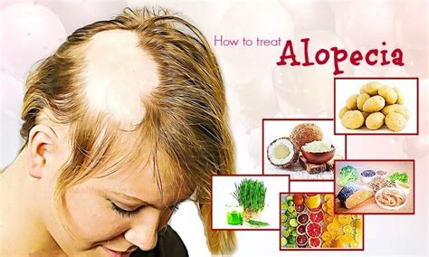 41 Tips How to Treat Alopecia Fast & Naturally in Men and Women