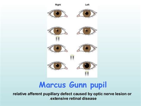 Ophthalmology Eponyms