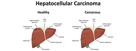 Hepatocellular Carcinoma: Causes, Symptoms And Treatment