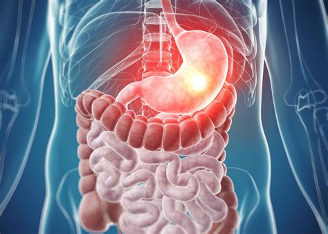 Symptoms and Causes of Peptic Ulcer Disease (Stomach Ulcers) - Medrot.com