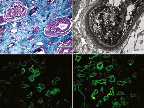 IgA kappa light and heavy chain deposition disease in multiple myeloma ...