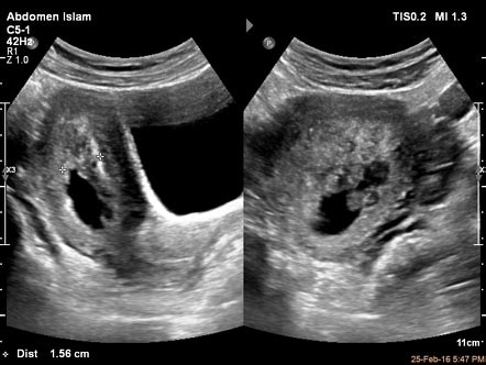 Complete hydatidiform mole | Radiology Case | Radiopaedia.org