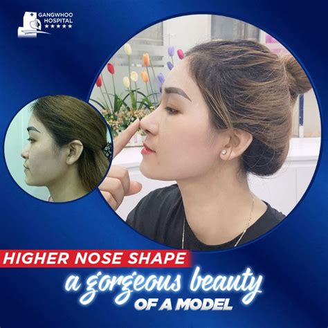 Rib Cartilage Rhinoplasty Procedure - Only in 7 Easy Steps - Gangwhoo Cosmetic Hospital - The ...