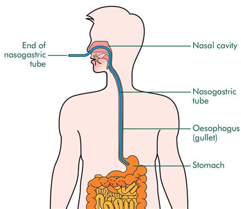 Nasogastric feeding tube . Causes, symptoms, treatment Nasogastric ...