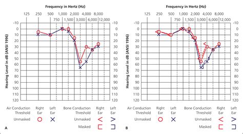 Audiometry Screening and Interpretation | AAFP