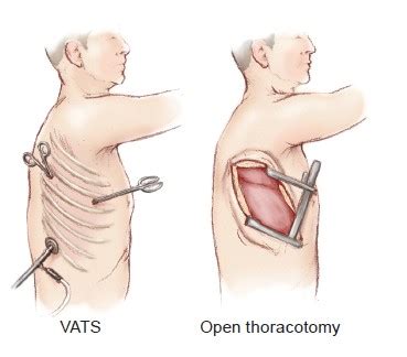 Minimally Invasive Pulmonary Resection - Harris- Annals of Cardiothoracic Surgery