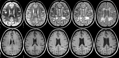 Diagnose: Diagnosing Ms With Mri