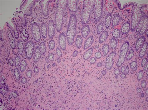 Pathology Outlines - Leiomyoma