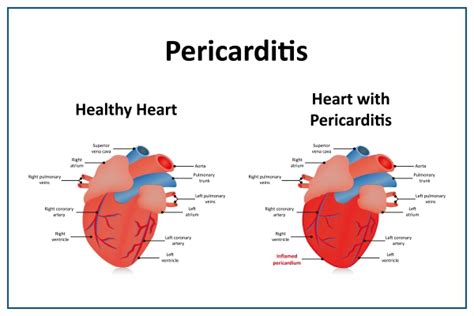 Pericarditis: Symptoms, Causes, Diagnosis, Prevention