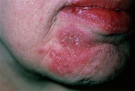 Facial Rash Of Systemic Lupus Erythematosus (sle) Photograph by Dr P. Marazzi/science Photo Library