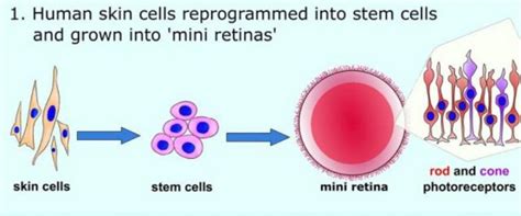 New gene therapy approach may offer a new treatment for retinitis pigmentosa (RP) | UCL ...