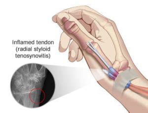 Radial Styloid Tenosynovitis Treatment Doctors in Brooklyn NYC