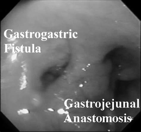 Gastrogastric fistula demonstrated by upper endoscopy. | Download Scientific Diagram