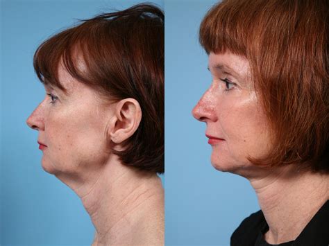 Neck Lift Before & After Photos Patient 145 | Chicago, IL | TLKM Plastic Surgery