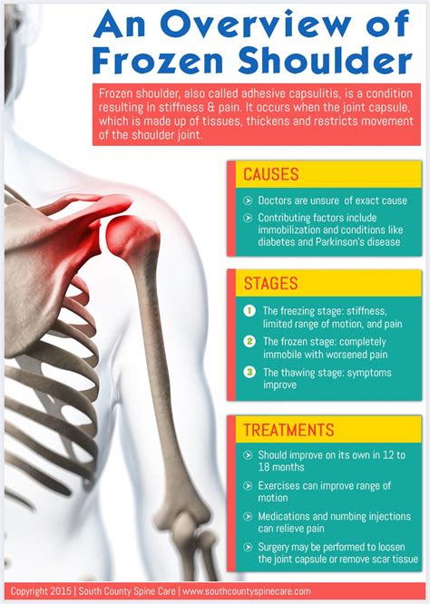 An Overview of Frozen Shoulder | Frozen shoulder, Shoulder surgery, Shoulder problem