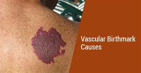 What Causes Vascular Birthmarks? | Fairview Laser Clinic Inc.