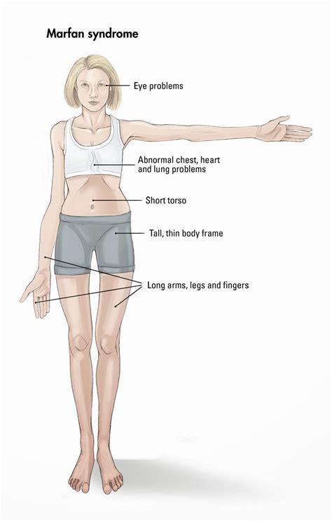 Blake's Honors Biology Blog: Marfan Syndrome