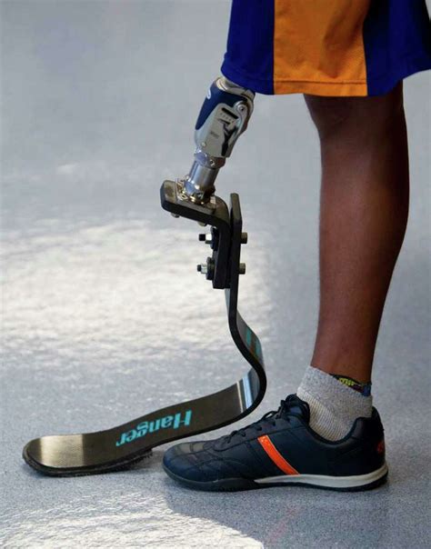 Runner from Mexico receives prosthetic leg