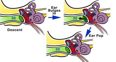 negative pressure | How to pop ears, Eustachian tube dysfunction, Treatment for tinnitus