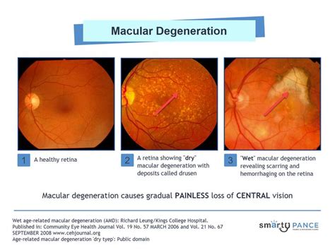 A Comparison of Wet and Dry Macular Degeneration | Macular degeneration, The retina, Wet and dry