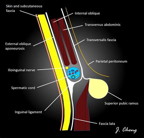 Inguinal canal: diagram | Radiology Case | Radiopaedia.org | Radiology, Medical ultrasound ...