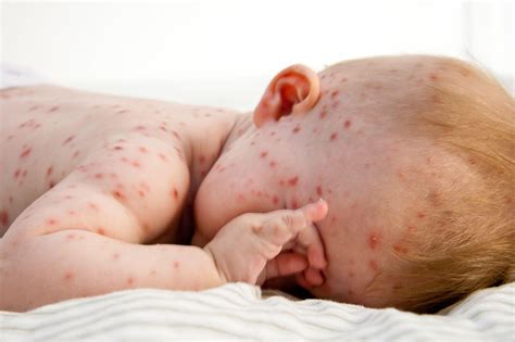 Rashes in babies and children - NHS