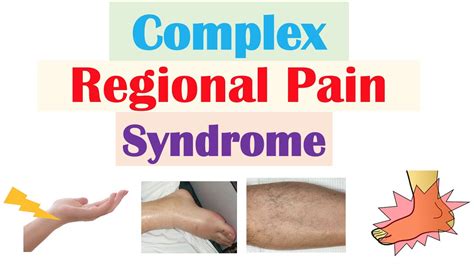 Complex Regional Pain Syndrome Causes, Pathophysiology,, 57% OFF