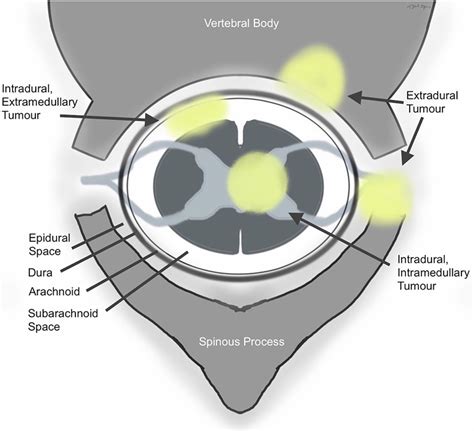 Combined intramedullary and intradural extramedullary spinal metastases in malignant melanoma ...