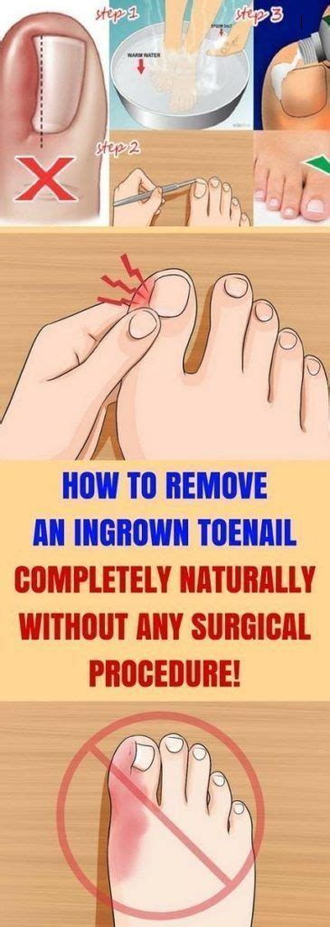 6 Natural Remedies For Ingrown Toenails | Ingrown toe nail, Health, Toe nails