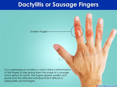 Image result for remicade | Arthritis in fingers, Psoriatic arthritis, Psoriasis image