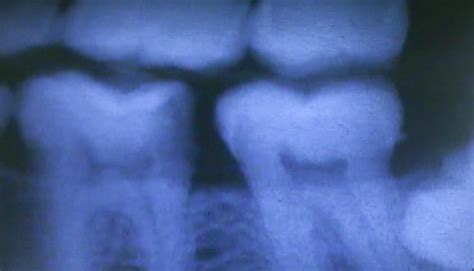 Tooth Pulp Infection - III.3 – The Center for Dental Education