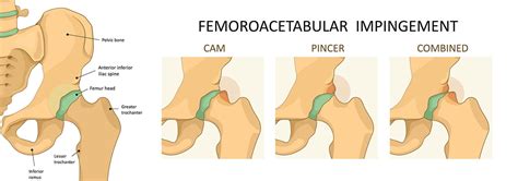 hip labrum surgery complications