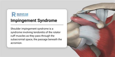 Impingement Syndrome - NJ's Top Orthopedic Spine & Pain Management Center