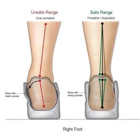 Feet Overpronation Causes, Treatment, & Prevention – OrthoFeet