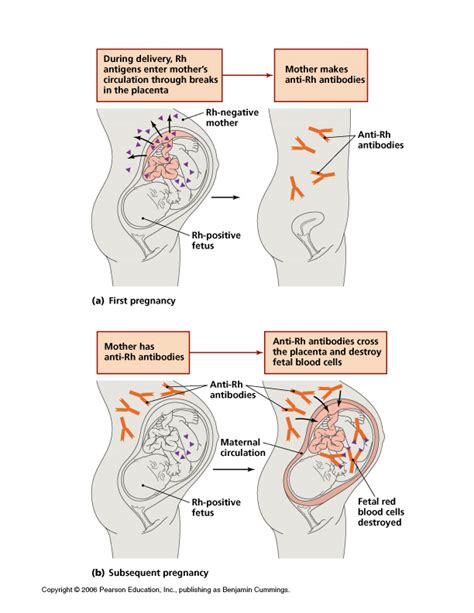 Hemolytic Disease of the Fetus and Newborn (HDFN) - Med Lab Study Hall