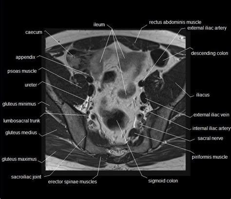 MRI pelvis anatomy | free male pelvis axial anatomy | Pelvis anatomy, Anatomy images, Pelvis