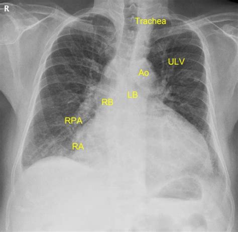 Cardiomegaly Chest X Ray