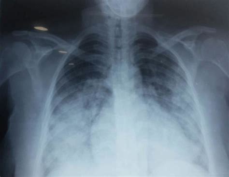 Radiographie pulmonaire de face: surcharge péri-hilaire en faveur d'un OAP | Download Scientific ...