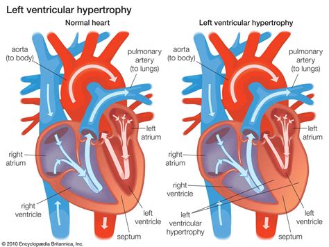 What Causes Hypertrophy Of The Heart