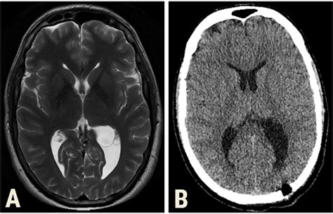 A -axial T2 MRI showing choroid a plexus cyst in the trigone of the ...