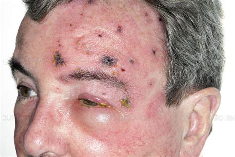 Science Source - Shingles rash on the face