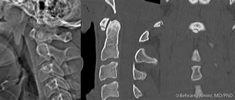 Roentgen Ray Reader: Inferior Accessory Ossicle of the Anterior Arch of C1