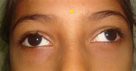 Divergent Squint - Exotropia - Utsav Eye Clinic